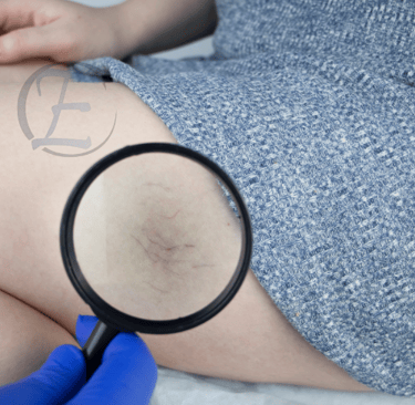 ANALISE DE MICROVASOS PARA RETIRAR COM ESCLEROTERAPIA