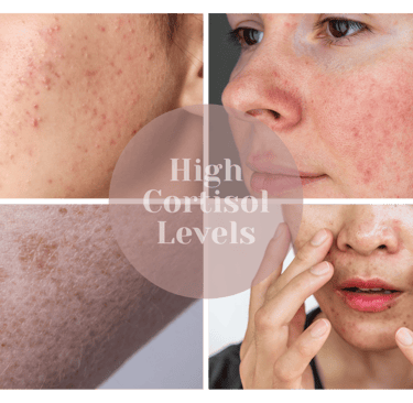 skin conditions linked to high cortisol
