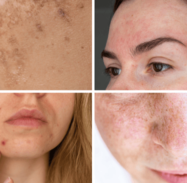 a woman with freckered skin Melasma, high cortisol, acne, hyperpigmentation