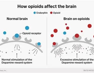 A visual comparion between the normal human brain and brain on opiods