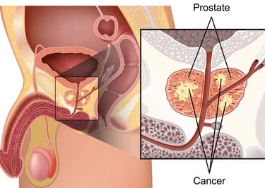 Prostate cancer image