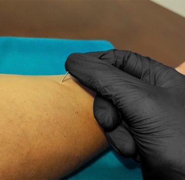 łokieć golfisty igłoterapia Kłodzki Fizjo