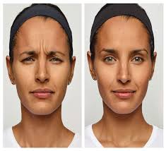 Botox Treatment Before and After