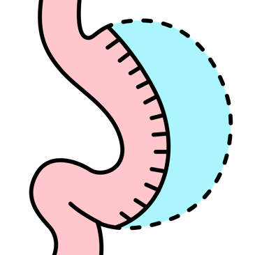sleeve gastrectomy