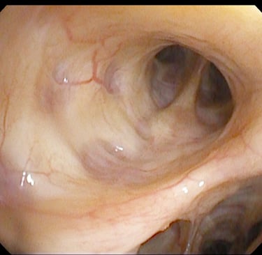 Bronchoscopy in Malta