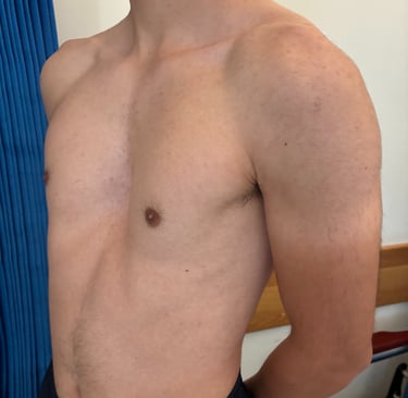 Pectus Excavatum surgery in Malta