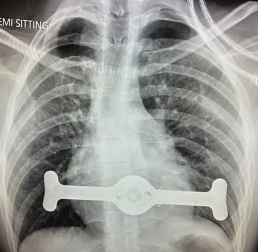 Pectus-Up Operation Malta