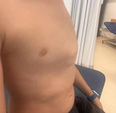 Pectus Carinatum expert specialist treatment