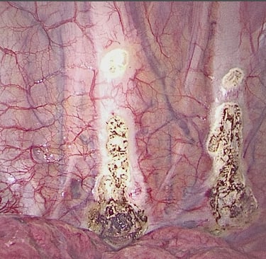 Sympathectomy sweating hyperhydrosis