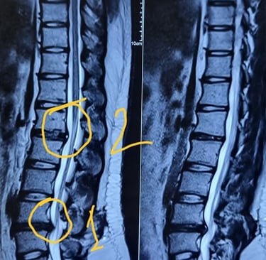 Disc prolapse occurs when a spinal disc bulges or ruptures, causing back pain, numbness, or weakness