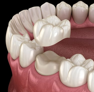 Corona dentale