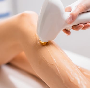 laser hair removal on legs