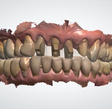 scan dental para implantes dentales