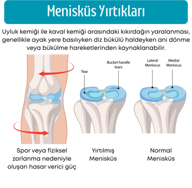 menisküs yırtıkları
