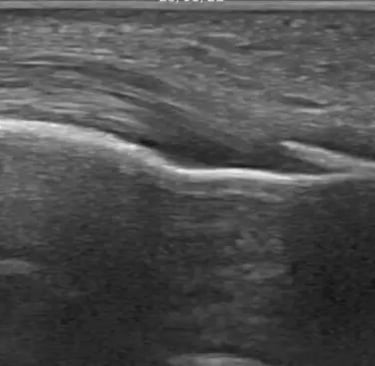 Imagen Ecográfica Calcificación en Aquiles