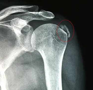 Radiografia de una calcificación en el tendón del hombro