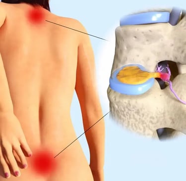 Hernia Lumbar y Cervical