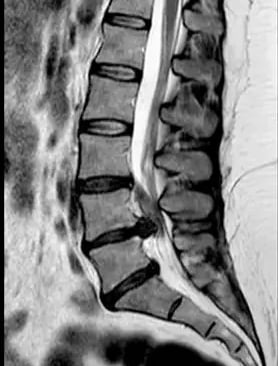 RMN de hernia lumbar
