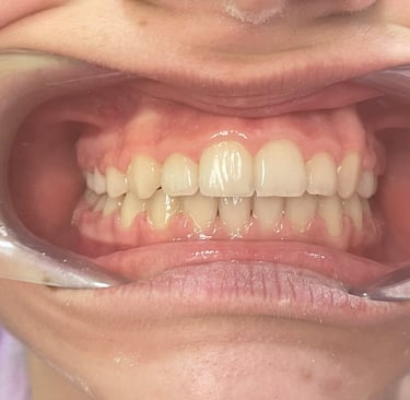 Proste zęby po leczeniu ortodontycznym