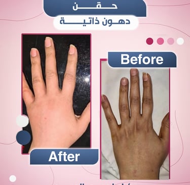 حقن الدهون الذاتية لليدين مع استشاري جراحة التجميل الدكتور ابراهيم العبد
