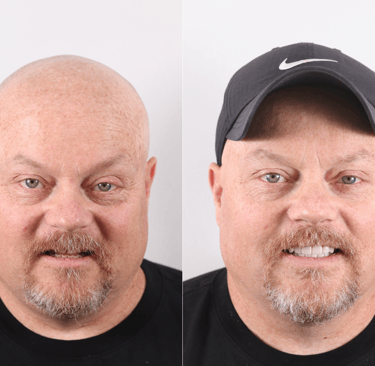 Before and after full zirconium crowns in los algodones mexico