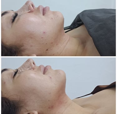 Masaje linfático postoperatorio en cuello y papada para reducir fibrosis después de cirugía estética