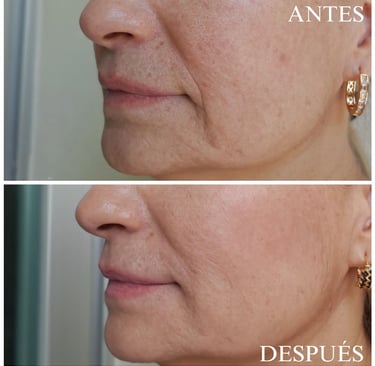 Relleno ácido hialurónico pliegues nasogenianos antes y después