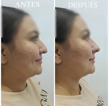 Rinomodelación perfil nariz curva antes y después
