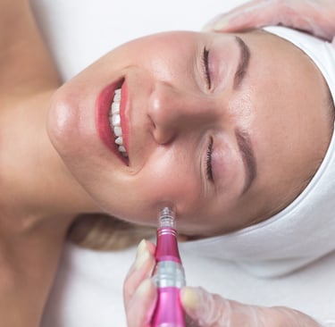 Microneedling Stafford