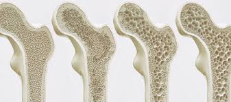 Ostéoporose et ostéopathie