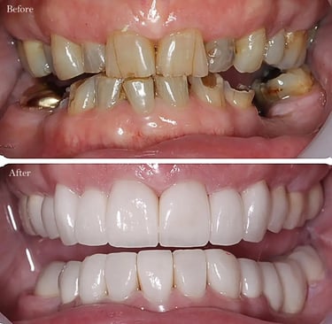 Before and after crowns
