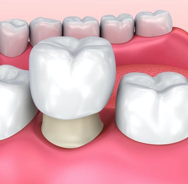 a dental implanting procedure on a toothbrush