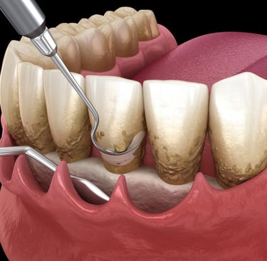 Image of Gum Disease Therapy 