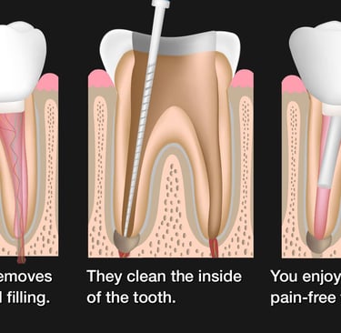 Root Canal Procedure Image