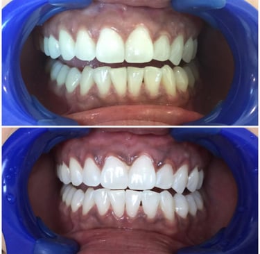 a close up of a smile with a smile on the bottom of the teeth