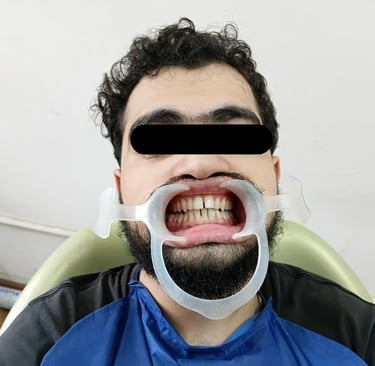 Fracture teeth post treatment at Rps Dental Clinic in Ranchi