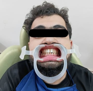 Lower fractured lateral incisor at Rps Dental Clinic in Ranchi