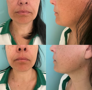 M3 Milennia neulaton mesoterapia