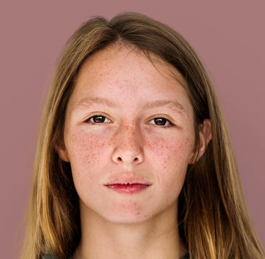 using salicylic acid for treating acne