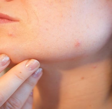 Acne on girl's face