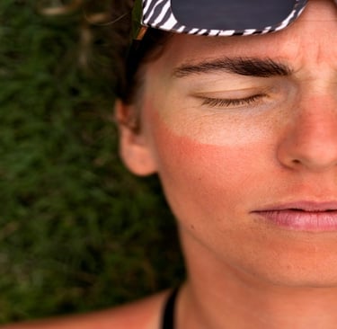 Woman with sunburn skin