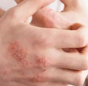 Close-up of a person's hands showing red, scaly skin patches indicative of psoriasis or eczema symptoms.
