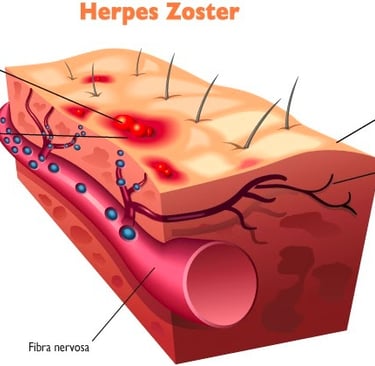 herpes zoster, dor neuropática, dor muscular