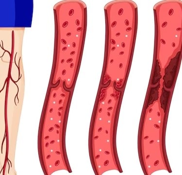 trombose, veias, artérias
