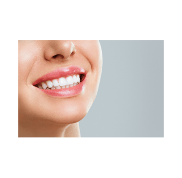 Close-up of a smiling woman with white, perfectly aligned teeth, showcasing a successful cosmetic de