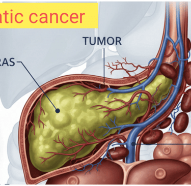 Pancreatic cancer,, naturopathy treatment, yoga therapy, causes of cancer, symptoms of cancer.