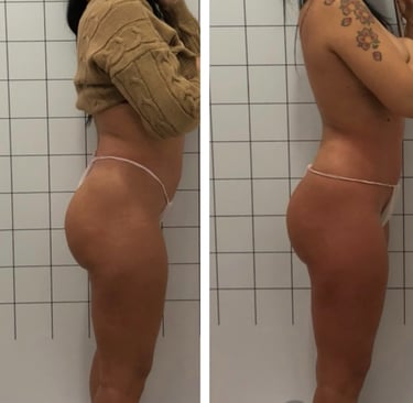 Body contouring NYC – before and after results