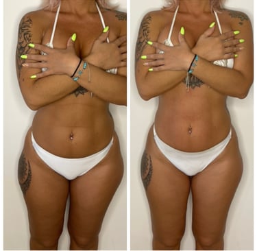 RF tightening and drainage – sculpting results NYC