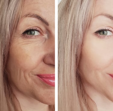 woman's face before and after skin tightening treatment