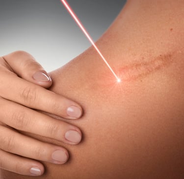 close up of red laser beam on scar for skin treatment